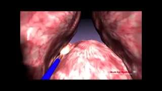 Quanta System  BPH  3D Enucleation median lobe  Thulium Laser [upl. by Ahtnicaj576]