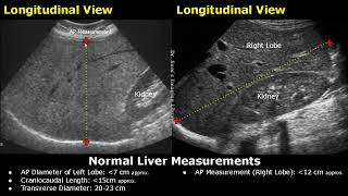 How To Measure Liver On Ultrasound  Craniocaudal Length Transverse Volume amp AP Measurements USG [upl. by Ttayw854]