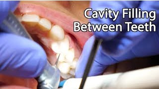 Filling cavities between teethchewing surfaces Root canal and postampcrowns Josutidentaltalk [upl. by Gahan]