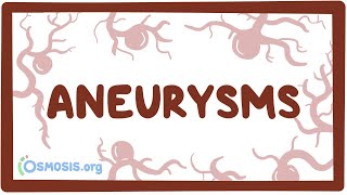 Aneurysms  causes symptoms diagnosis treatment pathology [upl. by Yelha]