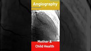 Coronary Angiography [upl. by Kassia]