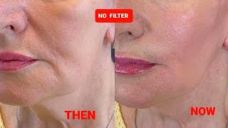 AMAZING LIFTING Massage  Sagging jowls  Nasolabial folds  Marionette lines  Double chin [upl. by Amadis]