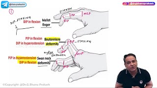 Rheumatoid arthritis Hindi  Causes Symptoms Diagnosis and Treatment  Orthopedic Lectures [upl. by Janeen]