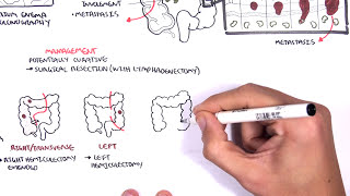 Colorectal Cancer  Overview [upl. by Nonnarb]