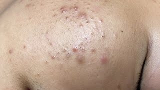 ACNE TREATMENT VU QUYNH MI  Perennial Blackheads On Boy Face 2024FULL [upl. by Ramal]