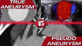 True Aneurysm vs Pseudoaneurysm [upl. by Nahallac562]