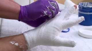 Changing a hand wrapping bandage after a burn injury [upl. by Llertnov860]