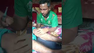 কিভাবে হাটু থেকে পানি বের করতে হয় How to aspirate synovial fluid from [upl. by Akenahc370]