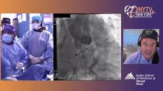 Live Case 2 – Evolut Pro CoreValve [upl. by Sined]