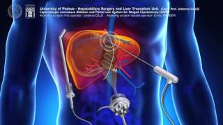 Modified ALPPS totally laparoscopic LAPS  ALPPS modificata LAPS totalmente laparoscopica [upl. by Noiro]