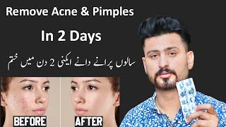 Best Treatment For Remove Pimple amp Acne In 2 Days  Pimples Removal Permanent On Face at Home [upl. by Lime]