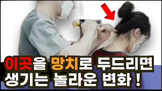 골타요법 뒷목을 망치로 두드리면 생기는 놀라운 변화 뒤통수 찌릿 후두신경통 치료 경추성 두통 치료법 뒷골이 땡기고 아플때 경추교정 [upl. by Salinas]