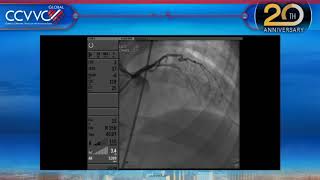 Live Case 11  PCI of Chronic CTO of mid LADDiagonal Bifurcation  CCVVC 2017 [upl. by Liggett208]