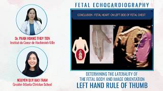 DETERMINING THE LATERALITY OF THE FETAL BODY  LEFT HAND RULE OF THUMB  FETAL ECHOCARDIOGRAPHY [upl. by Ynoyrb]