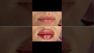 Lips filler injection [upl. by Adrianna]