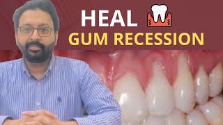 Gum Massage to Heal Receding Gums and Grow Gums Back [upl. by Niwrad99]