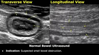 Small Bowel Ultrasound Reporting  How To Write USG Report  Bowel Obstruction Crohns Disease [upl. by Connelley453]