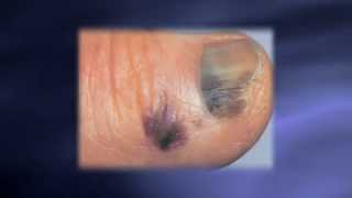 Skin Exams Catching Melanoma Earlier [upl. by Mavilia]