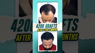 4200 Grafts Hair Transplant  Bangladesh hairtransplant bangladesh hair shorts [upl. by Santoro391]