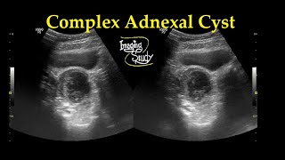 Complex Adnexal Cyst  Ultrasound  Case 27 [upl. by Aneej255]