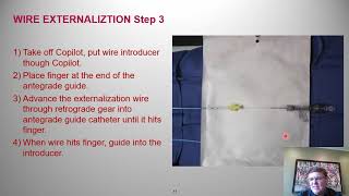 Guidewire externalization Stepbystep  Tony Doing MD [upl. by Nivrek803]