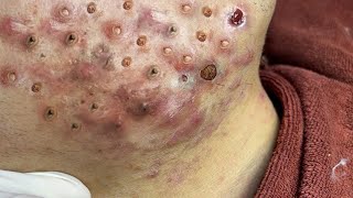 Big Cystic Acne Blackheads Extraction Blackheads amp Milia Whiteheads Removal Pimple Popping  5338 [upl. by Oruntha]