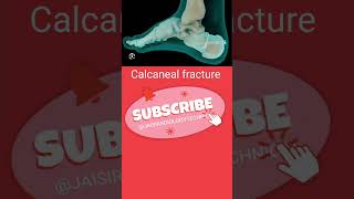 Calcaneal fracture anatomy orthopedics short [upl. by Nhguahs]