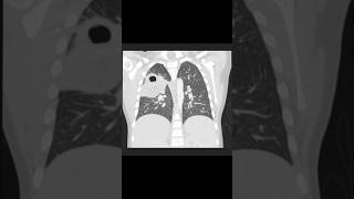 HRCT Chest Necrotizing pneumonia viralreels [upl. by Ellenhoj]