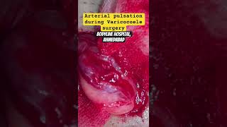 Testicular Artery pulsation during Varicocoele surgery varicoceletreatment andrologist urologist [upl. by Emanuela]