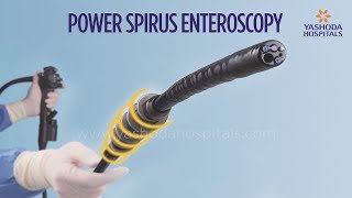 Power Spiral Enteroscopy A New Technology to Diagnose and Treat Small Intestine Diseases [upl. by Munson]