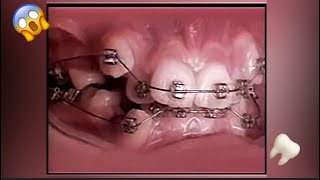 2 Years Of Braces In 20 Seconds Braces Timelapse Shorts [upl. by Robert]