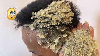 BOYS DANDRUFF Itchy psoriasis dandruff Scratching  V134 [upl. by Ahusoj]