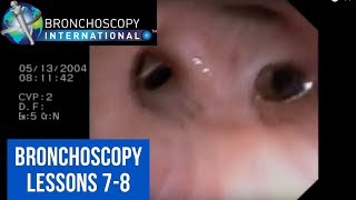 Bronchoscopy Step by Step Details Lessons 78 [upl. by Otreblaug]