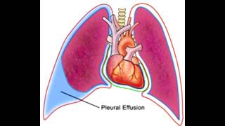 Pleural Effusions  Transudate Exudate amp Lymphatic [upl. by Vyse]