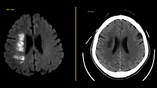 Acute right MCA infarct  CT [upl. by Snevets451]