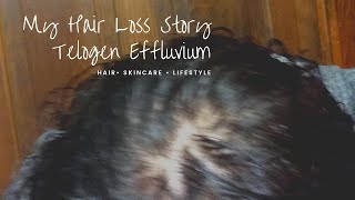 My Hair Loss Story Nioxin amp Redken [upl. by Derfnam]