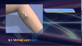 VenaCure EVLT Patient Video [upl. by Terry]