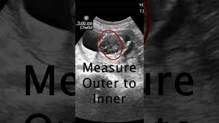 How to measure a Biparietal Diameter POCUS Ultrasound emergencymedicine obgyn [upl. by Templer]