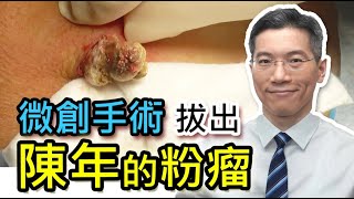 長者  背部長的腫瘤  陳年的粉瘤  Sebaceous Cyst  Epidermoid Cyst  微創手術  皮膚專科 [upl. by Norm]