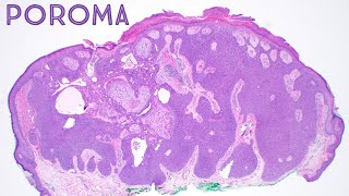 Poroma Dermpath in 5 Minutes dermatology pathology dermatopathology board review [upl. by Nylesaj939]