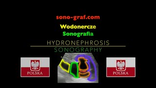 Sonografia  Wodonercze [upl. by Rama]