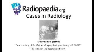 Erosive antral gastritis Radiopaediaorg Cases in Radiology [upl. by Attiuqram]