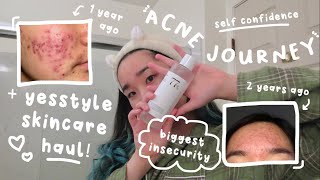 🌿my acne journey  YESSTYLE skincare🪞🎀 [upl. by Rimahs165]