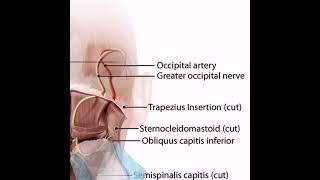 Greater Occipital Nerve block Ultrasound guidance for Refractory Headache [upl. by Particia]