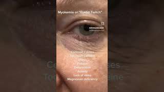 Myokymia or eyelid twitch youtubeshorts science medicalstudent shortsfeed biology [upl. by Aibar]