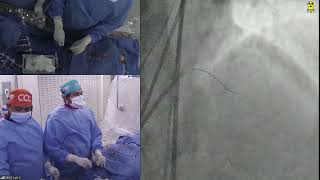 LIVE CASE 7  PCI of LAD CTO with Antegrade Wiring Technique [upl. by Marchese]