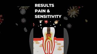 how bad bacterias affect your healthy toothmanagement of decayed tooth cavity  dental [upl. by Fendig]