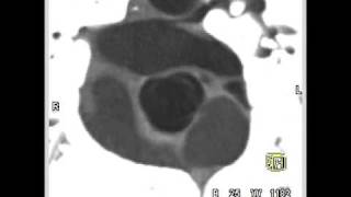 Cardiac diseased aortic valve with aortic valvular stenosis 6 of 10 [upl. by Mercer]