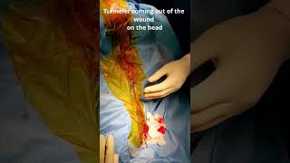 How We pass VP shunt tube beneath the skin with 2 small openings Neurosurgery OT VP shunt operation [upl. by Aelegna]