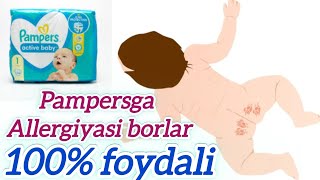 Pampersda bolaga allergiya bersa foydali 100 effekt beradi onalar uchun layfxak tavsiya qilaman [upl. by Sera609]